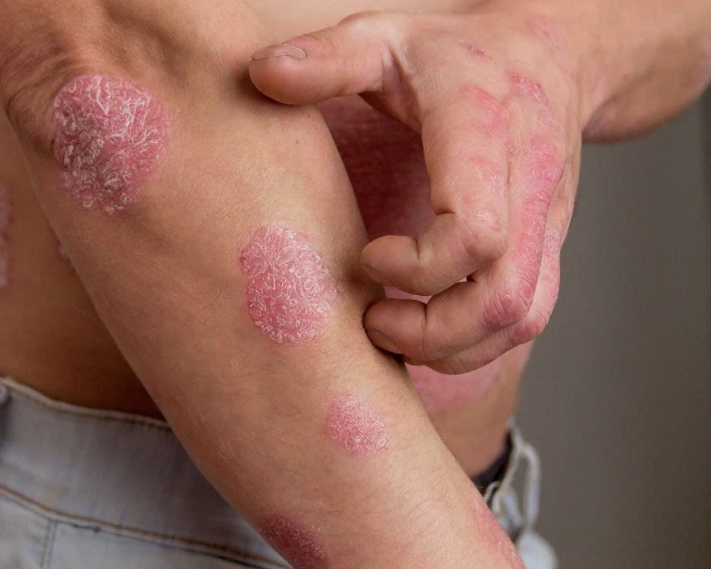 SRIMAYAM AYURVED - Psoriasis treatment in Gujarat